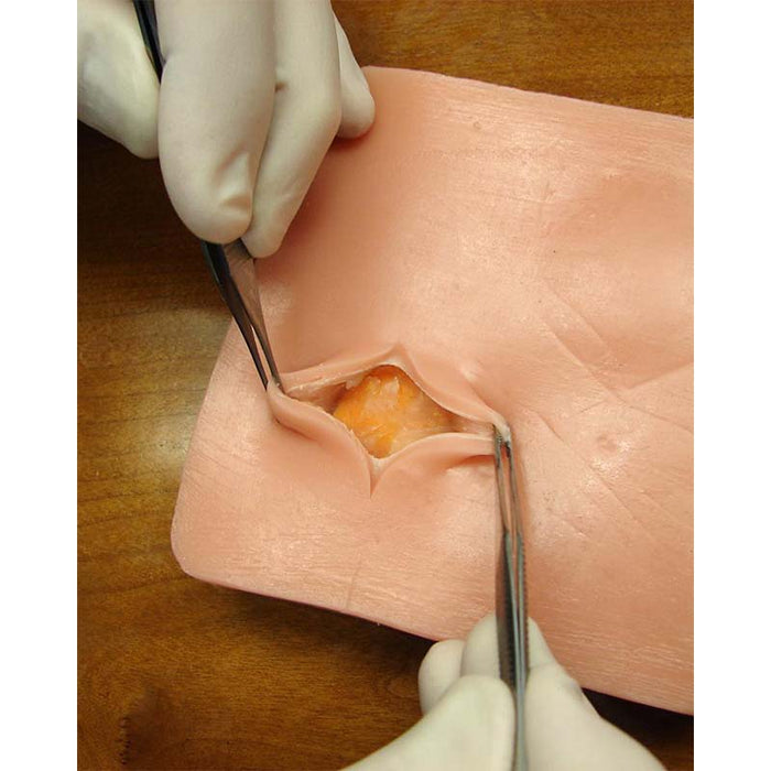 Image 3 - LIPOMA TISSUE PAD